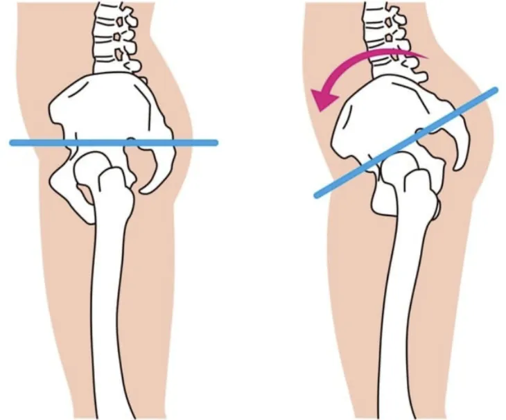骨盤の歪み